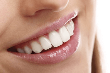 Допускается проведение виниринга на отдельных зубах